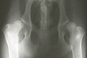Dysplázia bedrového kĺbu
